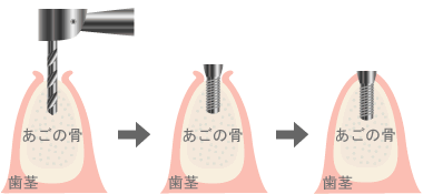 インプラント挿入